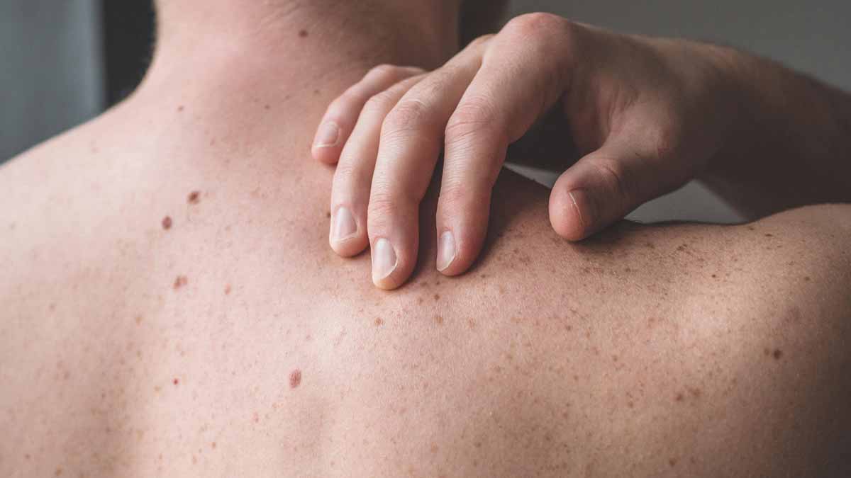 cancer de la peau